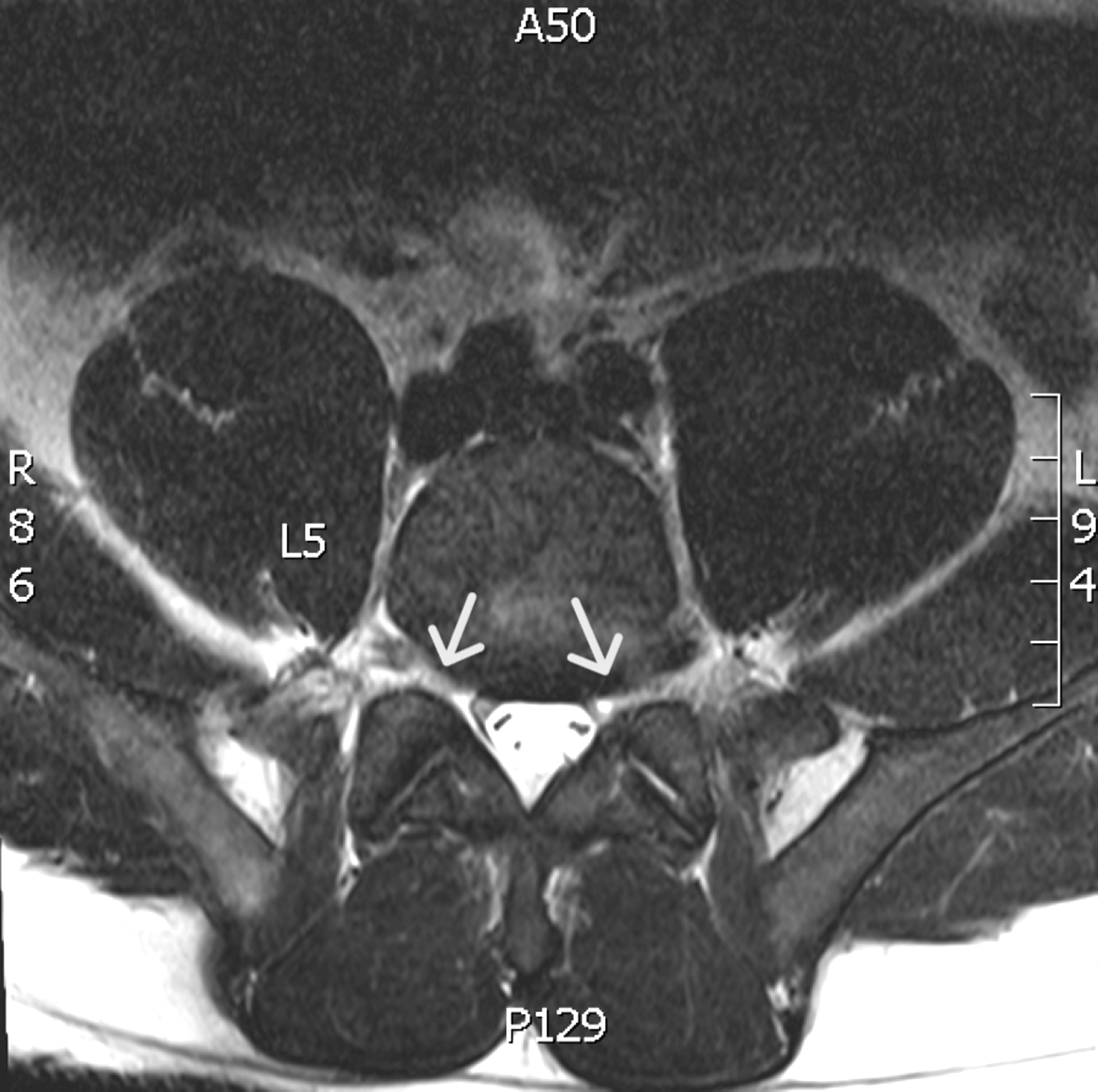 Cureus Livedoid Vasculopathy with Severe Debilitating Neuropathy in a
