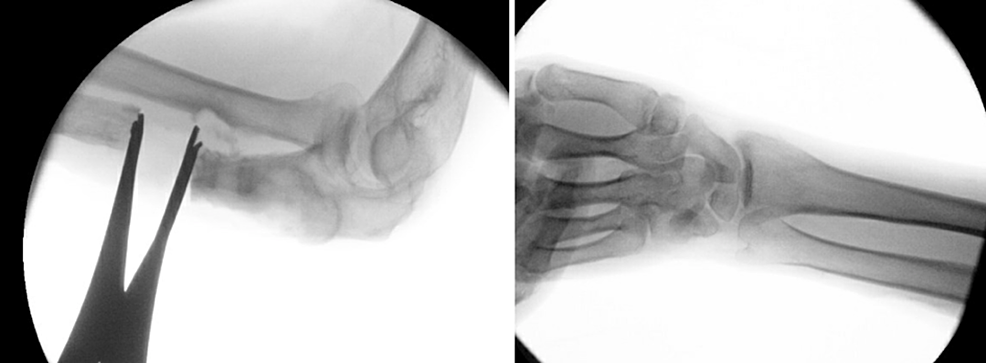 Figure Four Arm Lock Cureus Recalcitrant Septic Nonunion of the Ulna