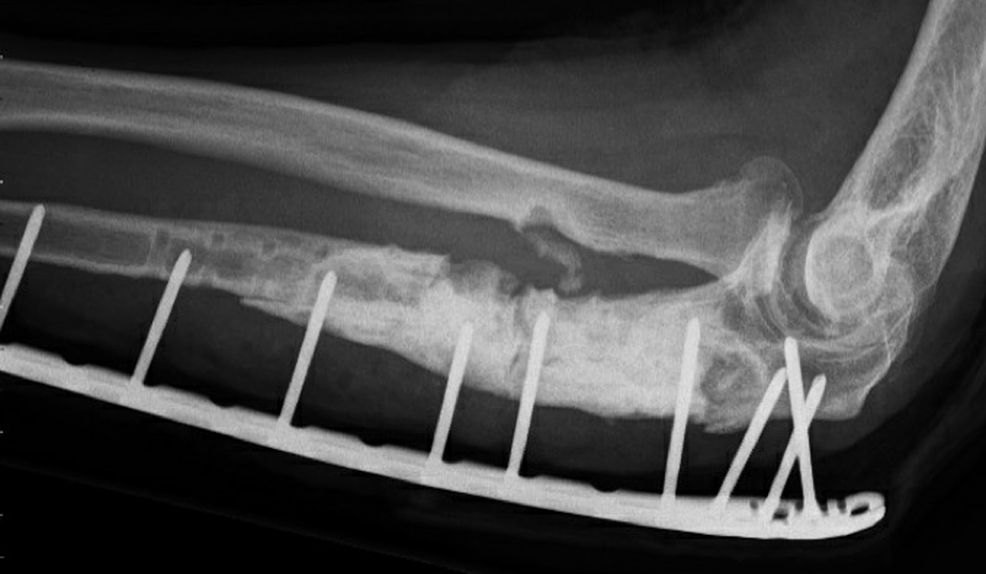 Figure Four Arm Lock Cureus Recalcitrant Septic Nonunion of the Ulna