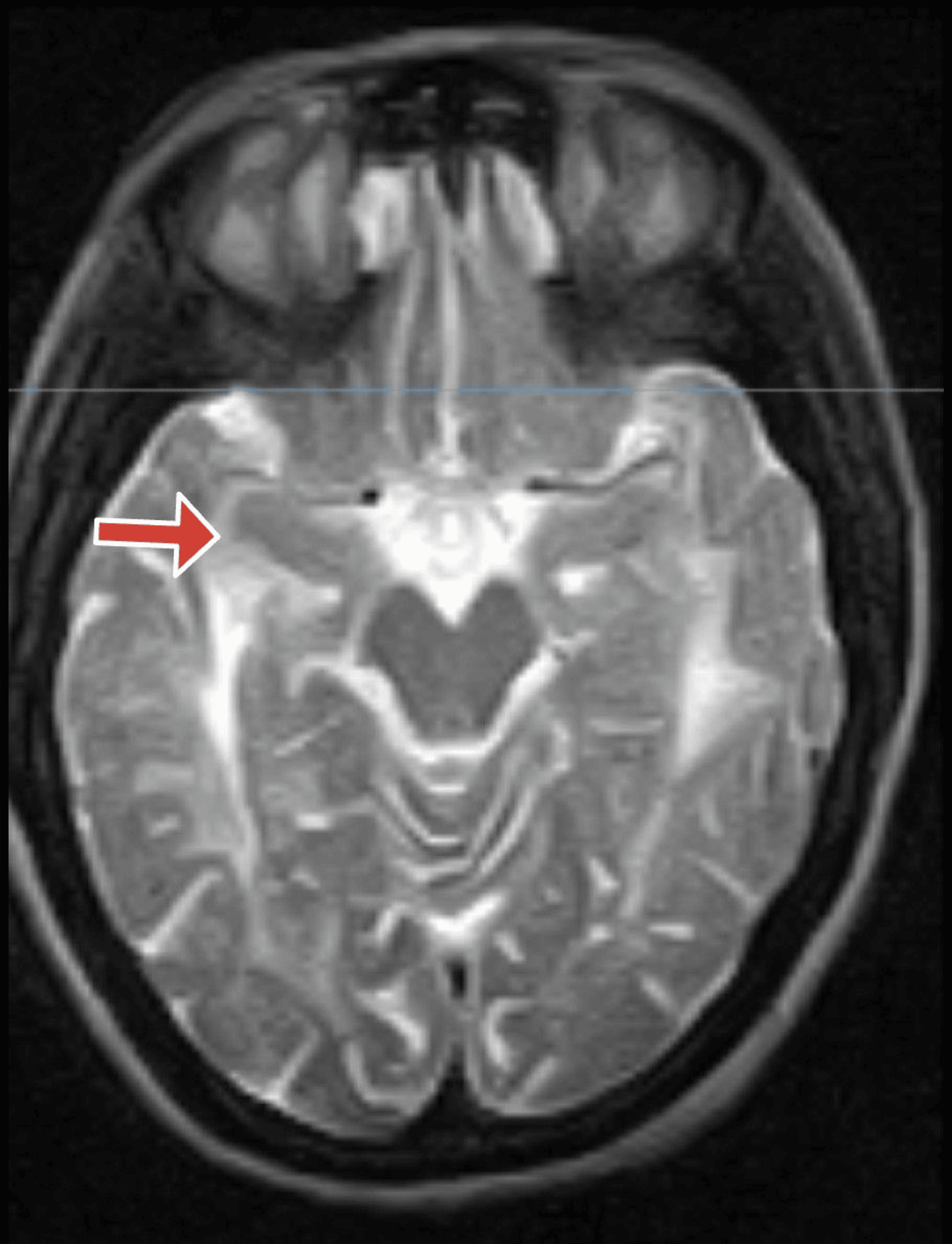 Cerebral Autosomal Dominant Arteriopathy With Subcortical Infarcts and ...