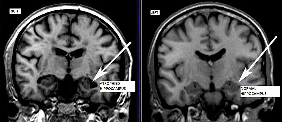 MRI-showing-atrophy-in-hippocampus-indicated-with-arrows