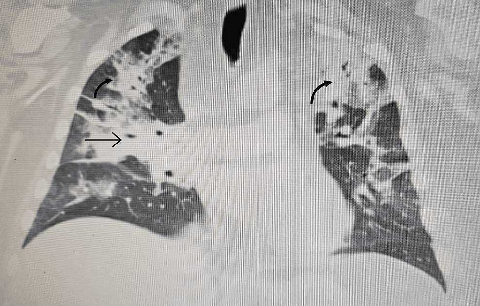A-chest-X-ray-revealing-(arrows)-bilateral-multilobar-pneumonia