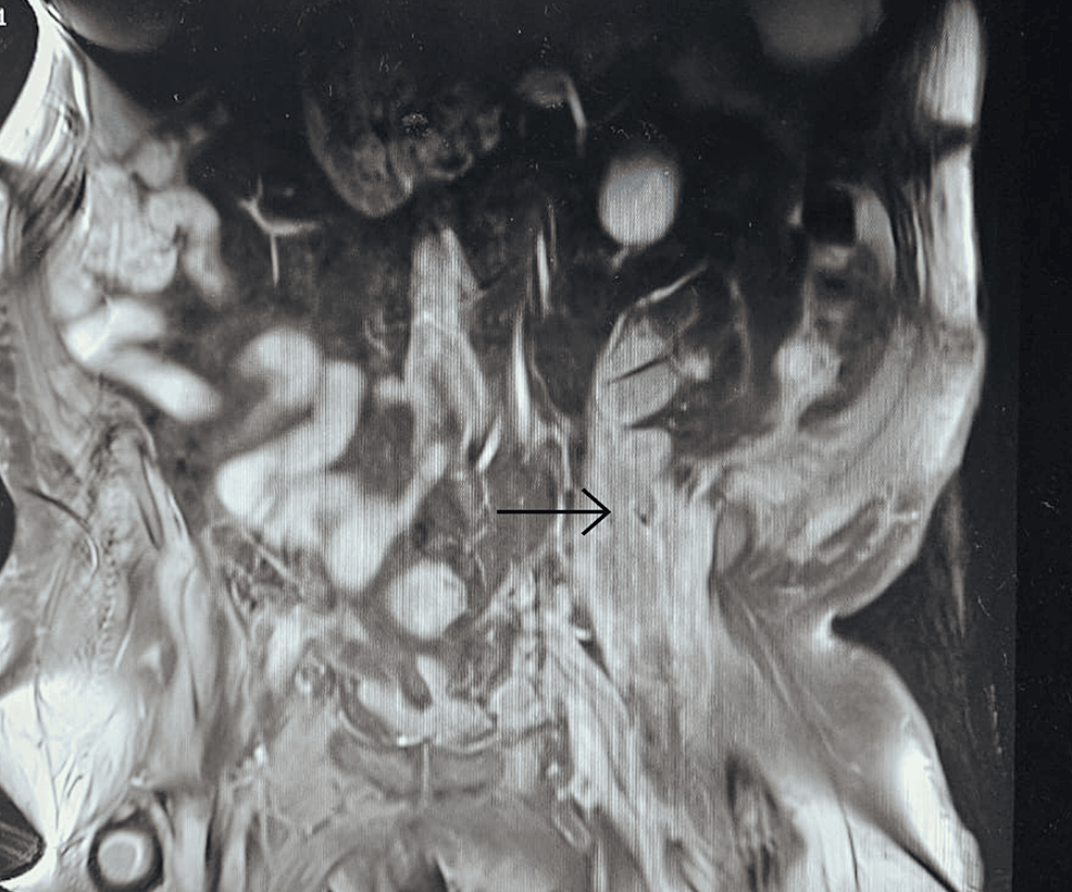 Magnetic-resonance-imaging-(MRI)-depicting-an-8x8-cm-hematoma-(arrow)-involving-the-left-psoas-and-iliacus-muscles