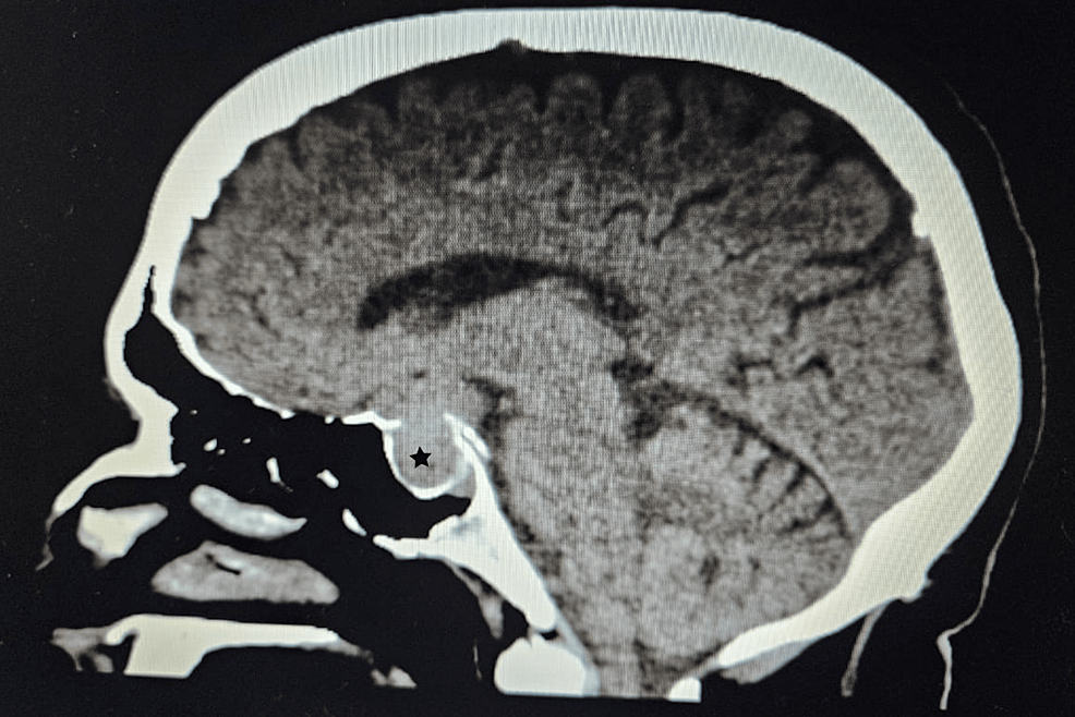 Magnetic-resonance-imaging-(MRI)-of-the-brain-depicting-a-1.3x1.3x3.2-cm-pituitary-macroadenoma-(star)