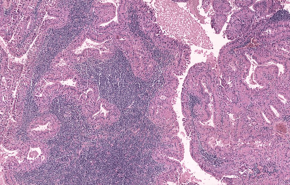 Show-a-well-circumscribed-tumor-with-a-papillary-architecture.-The-papillae-in-the-case-of-Warthin's-tumor-are-lined-by-bilayer-oncocytic-epithelial-cells-and-surrounded-by-a-lymphoid-stroma-(H&E,-x200).-