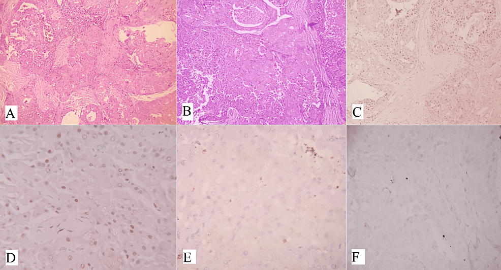 (A)-Shows-a-cystic-structure-lined-by-mucous-cells-and-solid-nests-of-epidermoid-cells-characterized-by-mucoepidermoid-carcinoma-(H&E,-x100).-(B)-Shows-extensive-oncocytic-differentiation-(H&E,-x200).-(C)-and-(D)-IHC-shows-tumor-cells-are-positive-for-(C)-GATA3-(x400)-and-(D)-P63-(x400).-(E)-S100-(x400)-and-(F)-AR-(x400)-are-negative.