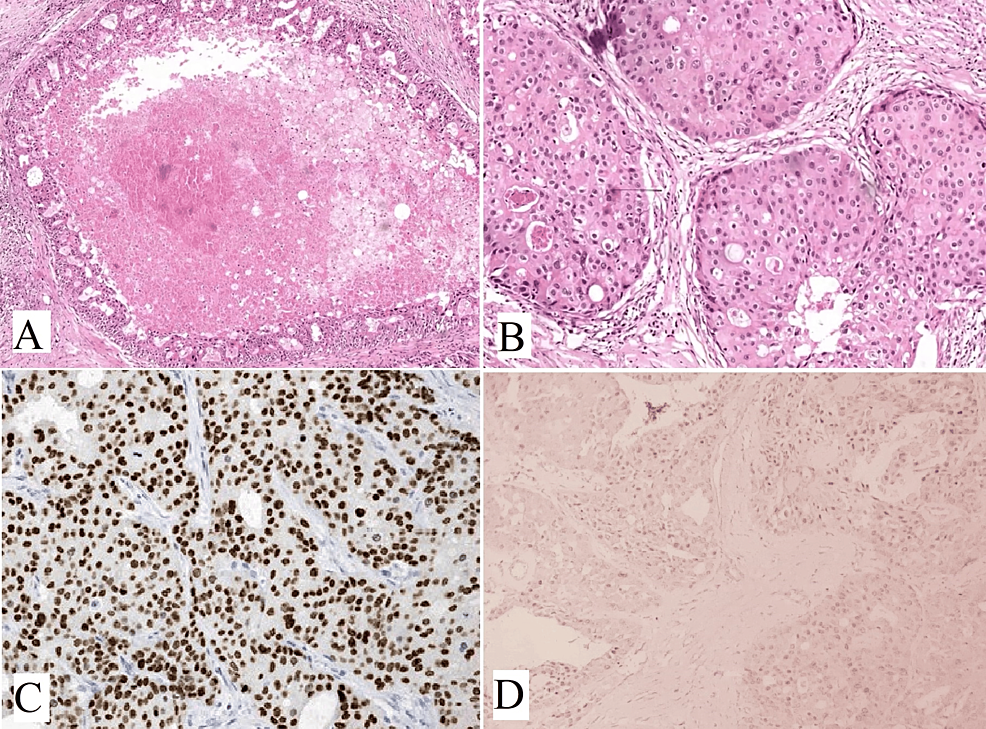 SDC-shows-tumor-cell-proliferation-with-central-necrosis-resembling-breast-ductal-carcinoma,-displaying-a-comedo-type-pattern.-(A)-and-(B)-The-tumor-cells-exhibit-large-pleomorphic-nuclei-with-prominent-nucleoli-and-abundant-eosinophilic-cytoplasm-(H&E,-x400).-(C)-Diffuse-and-strong-positive-immunohistochemical-staining-for-androgen-receptor-(x400)-and-(D)-GATA-3-(x200).