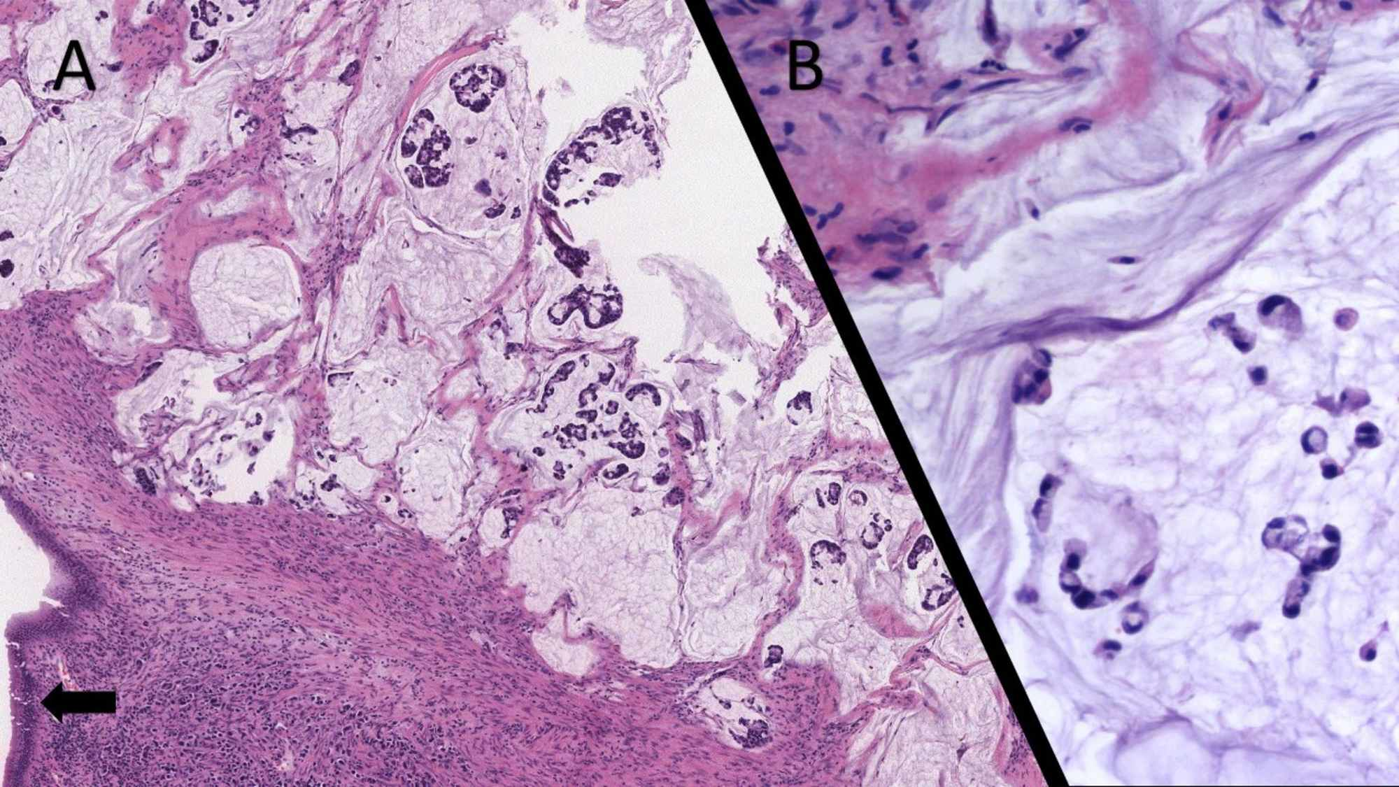 memo-jagen-melbourne-signet-ring-cell-adenocarcinoma-tafel-randstein