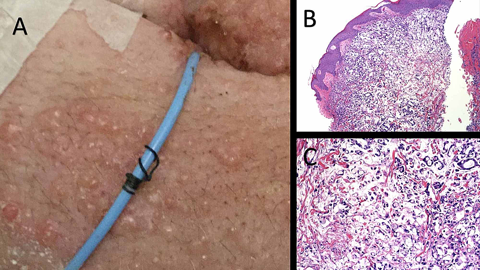 Cureus Most Common Pathway of Metastasis of Rectal Ring Cell