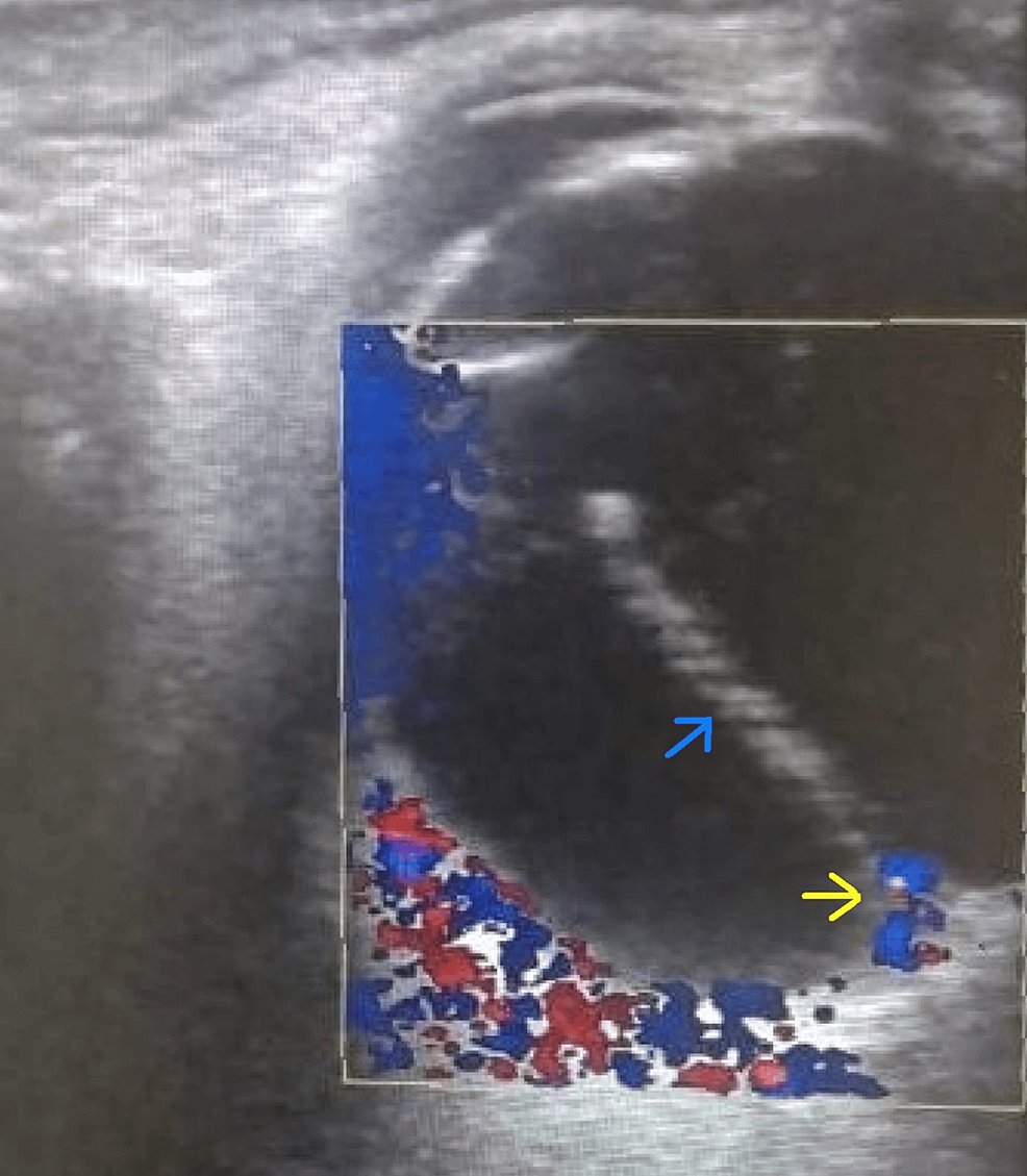 Myopic Posterior Persistent Fetal Vasculature A Rare Presentation Cureus