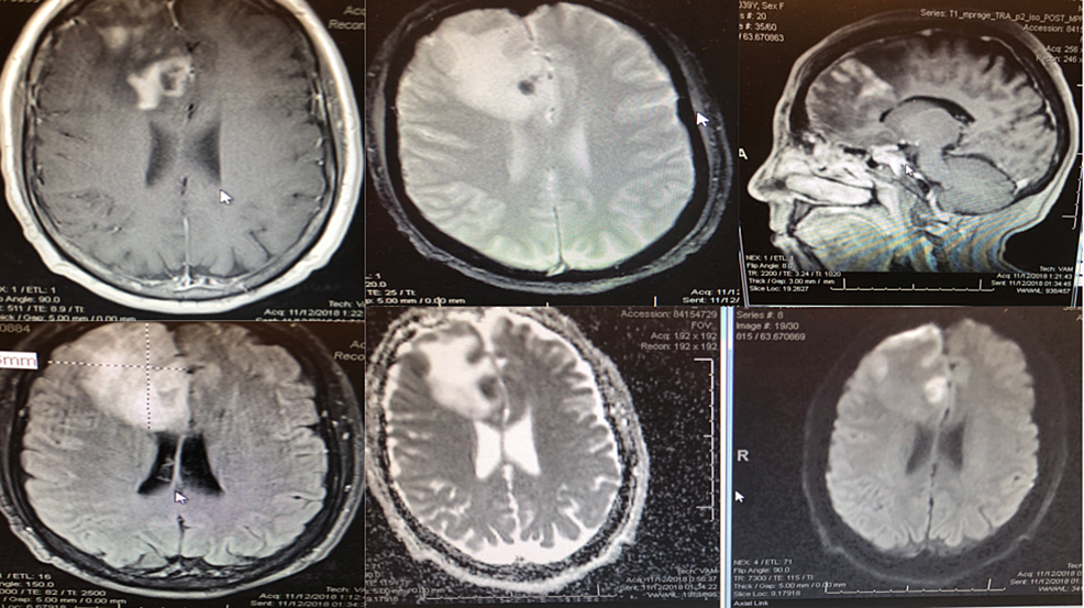 Cureus Primary Angiitis of the Central Nervous System Presenting as a