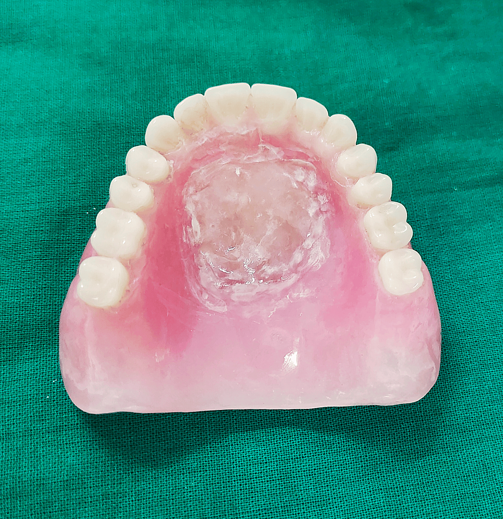 Dry Mouth Dilemma A Comprehensive Review of Xerostomia in Complete Denture Wearers Cureus