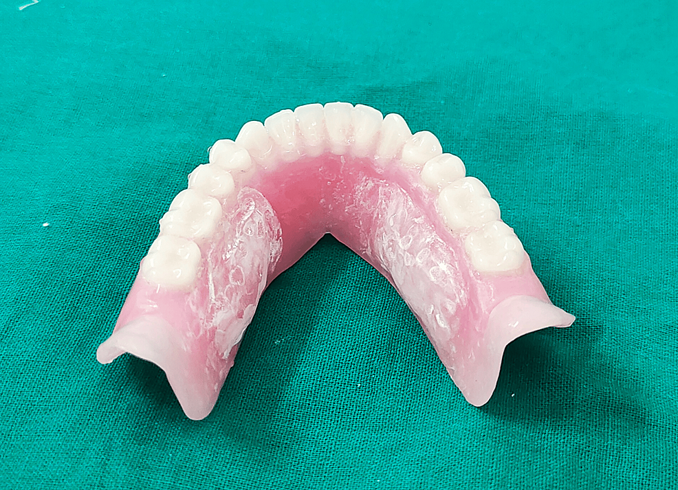 Dry Mouth Dilemma A Comprehensive Review of Xerostomia in Complete Denture Wearers Cureus
