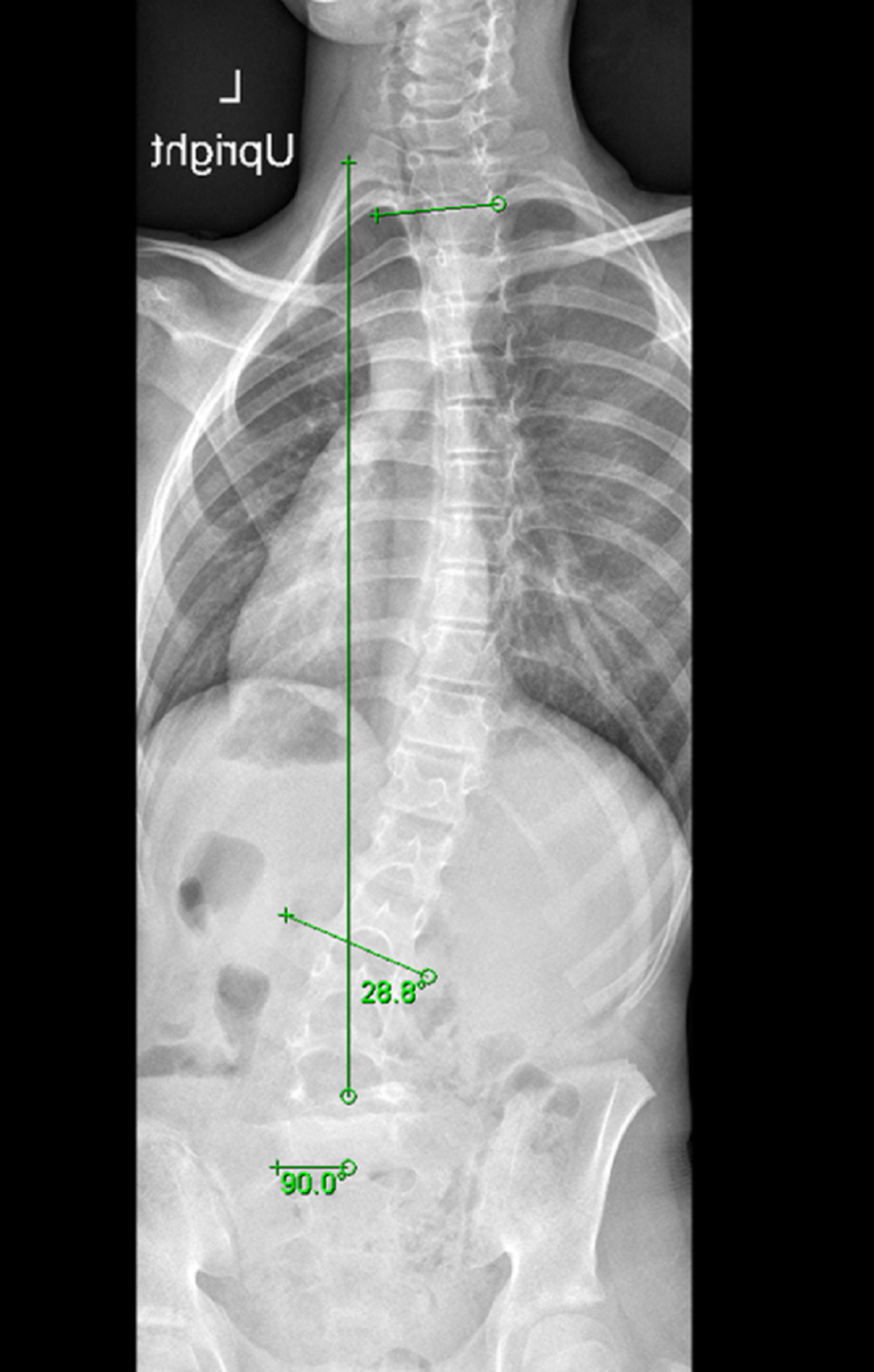 Cureus Scoliosis Associated With Lumbar Spondylolisthesis Spontaneous Resolution And Seven Year Follow Up