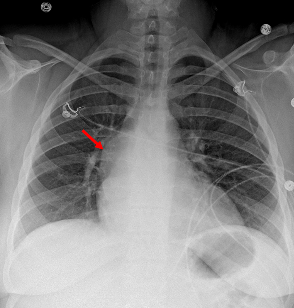 Chest-X-ray-(posteroanterior-view)-showing-abnormal-bulging-of-the-right-mediastinal-contour-(red-arrow),-suggestive-of-a-mediastinal-mass.