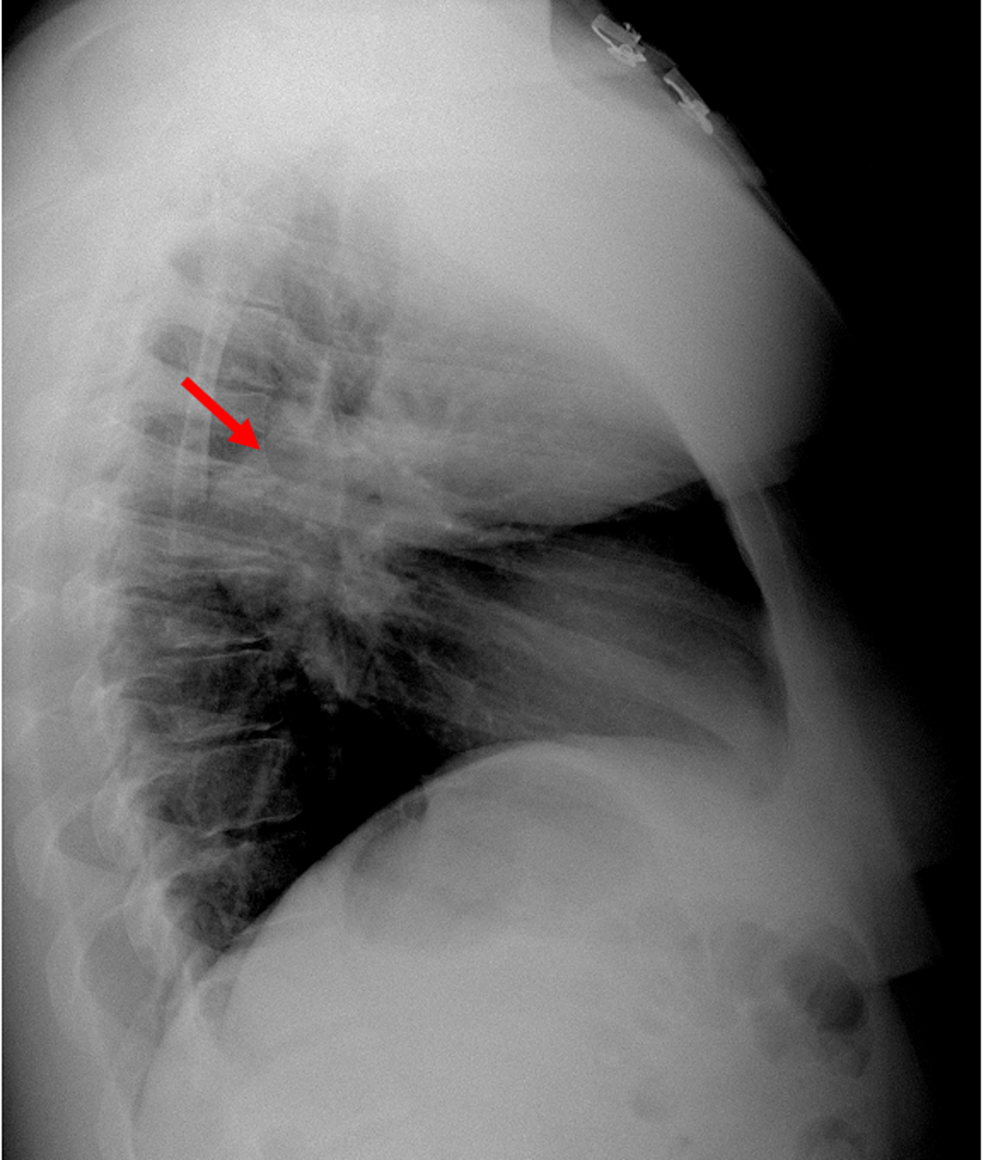 Chest-X-ray-(lateral-view)-showing-a-mass-like-lesion-in-the-posterior-mediastinum-(red-arrow).