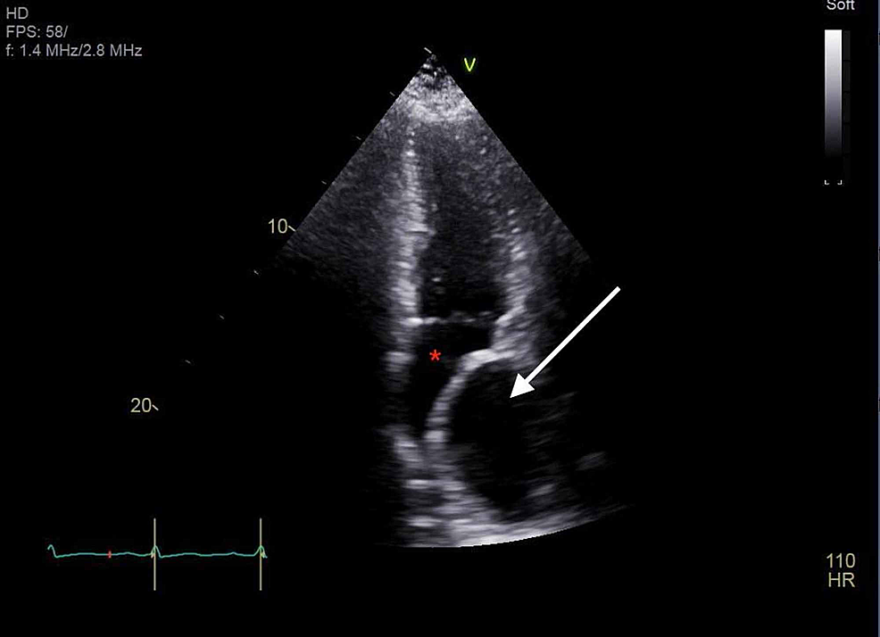 Transthoracic-echocardiogram-showing-cyst-like-structure-(white-arrow)-compressing-the-left-atrium-(red-asterisk).
