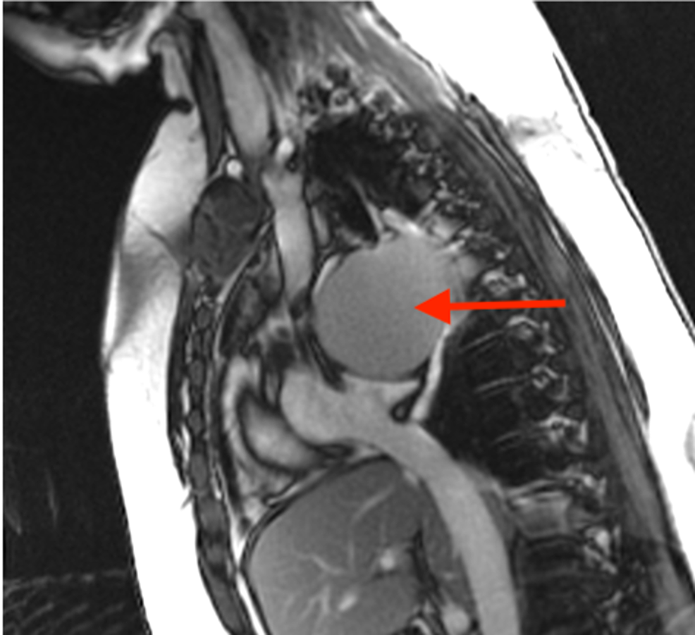 Cardiac-MRI-(FIESTA,-RVOT-view)-showing-an-8.2-cm-subcarinal-cystic-lesion-(red-arrow)-with-uniform-T2-hyperintensity,-exerting-mass-effect-on-the-left-atrium.-No-large-solid-component-is-identified.