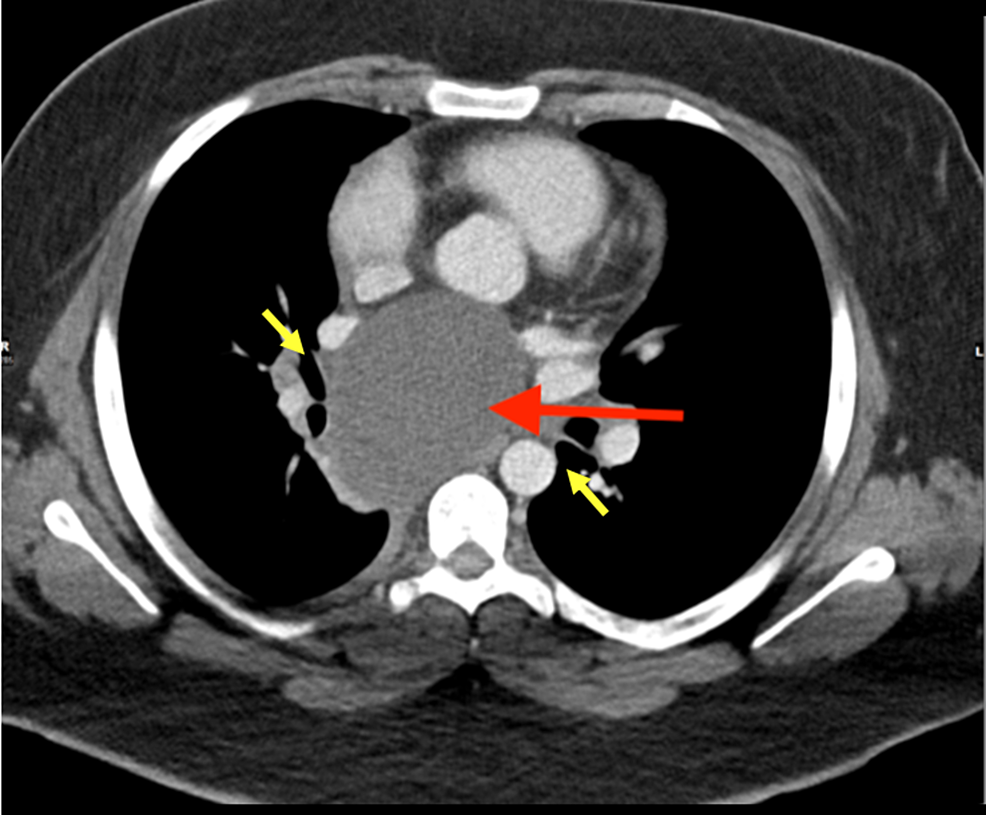 Chest-CT-(axial-view)-with-intravenous-contrast-showing-a-7.5-x-6.8-x-6.3-cm-mildly-complex-fluid-filled-thin-walled-subcarinal-mass-(red-arrow).-The-mass-is-splaying-the-right-and-left-mainstem-bronchi-(yellow-arrows).