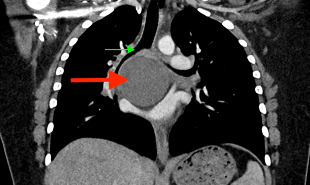 Chest-CT-(coronal-view)-with-intravenous-contrast-showing-thin-walled-cyst-(red-arrow)-in-the-subcarinal-region-with-internal-minimally-complex-fluid-density.-The-cyst-splays-the-right-and-left-mainstem-bronchus-(green-arrow).