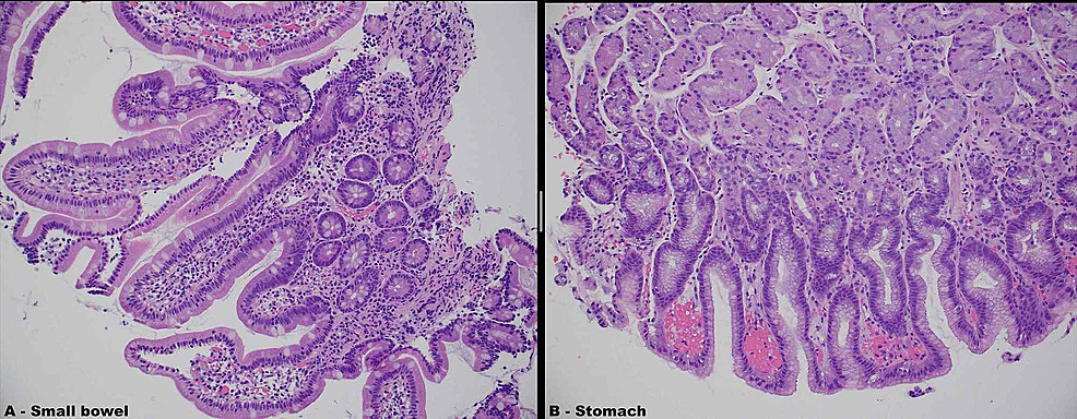 Cureus | A Flare-up of Systemic Lupus Erythematosus with Unusual ...