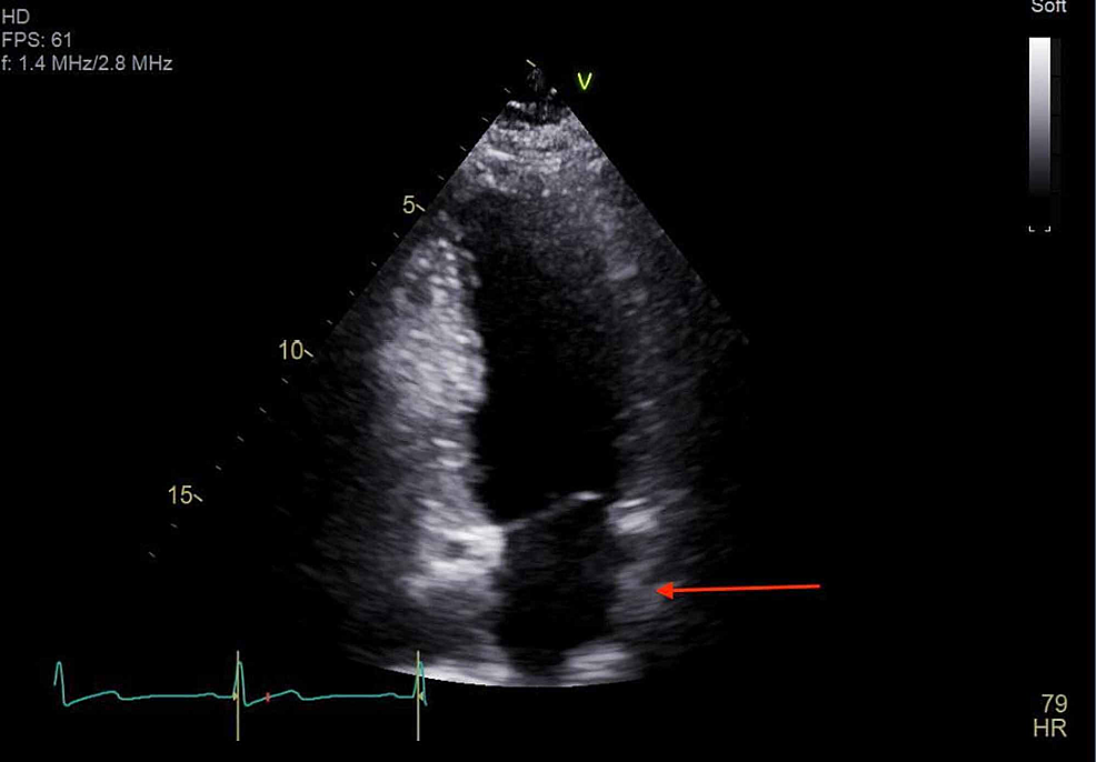 Transthoracic-echocardiogram-repeated-one-month-later-showed-thickening-(red-arrow)-near-the-left-atrial-wall-due-to-known-remnants-of-the-bronchogenic-cyst.