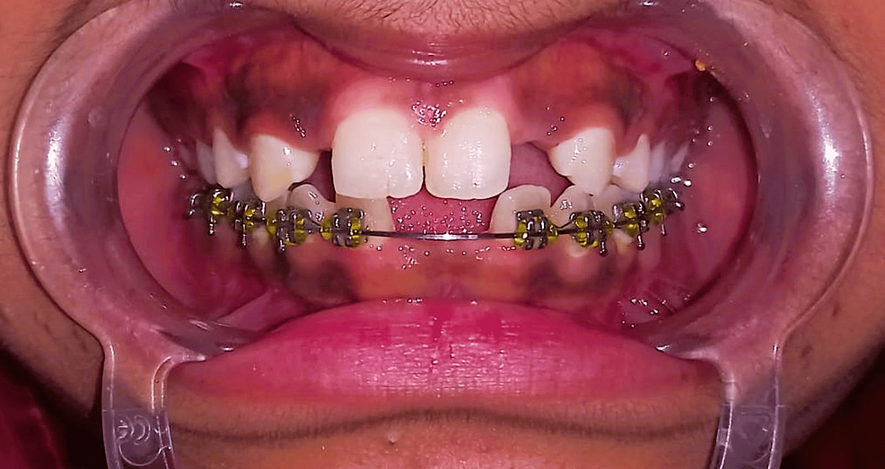 Rehabilitation of Congenitally Missing Bilateral Incisors With the