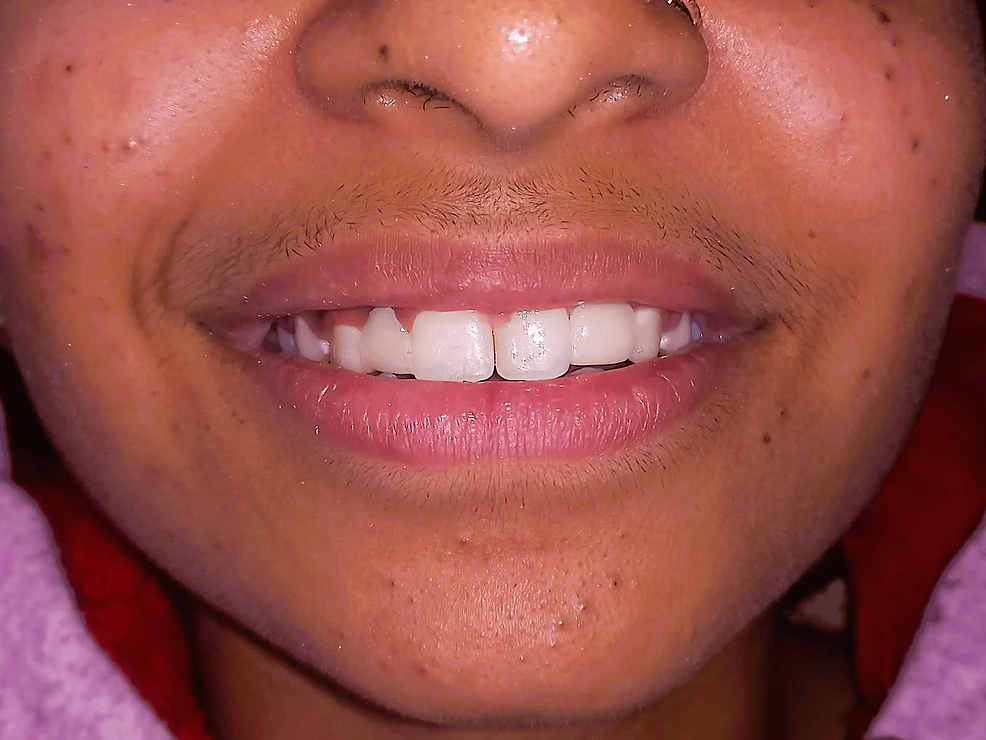 Rehabilitation of Congenitally Missing Bilateral Incisors With the