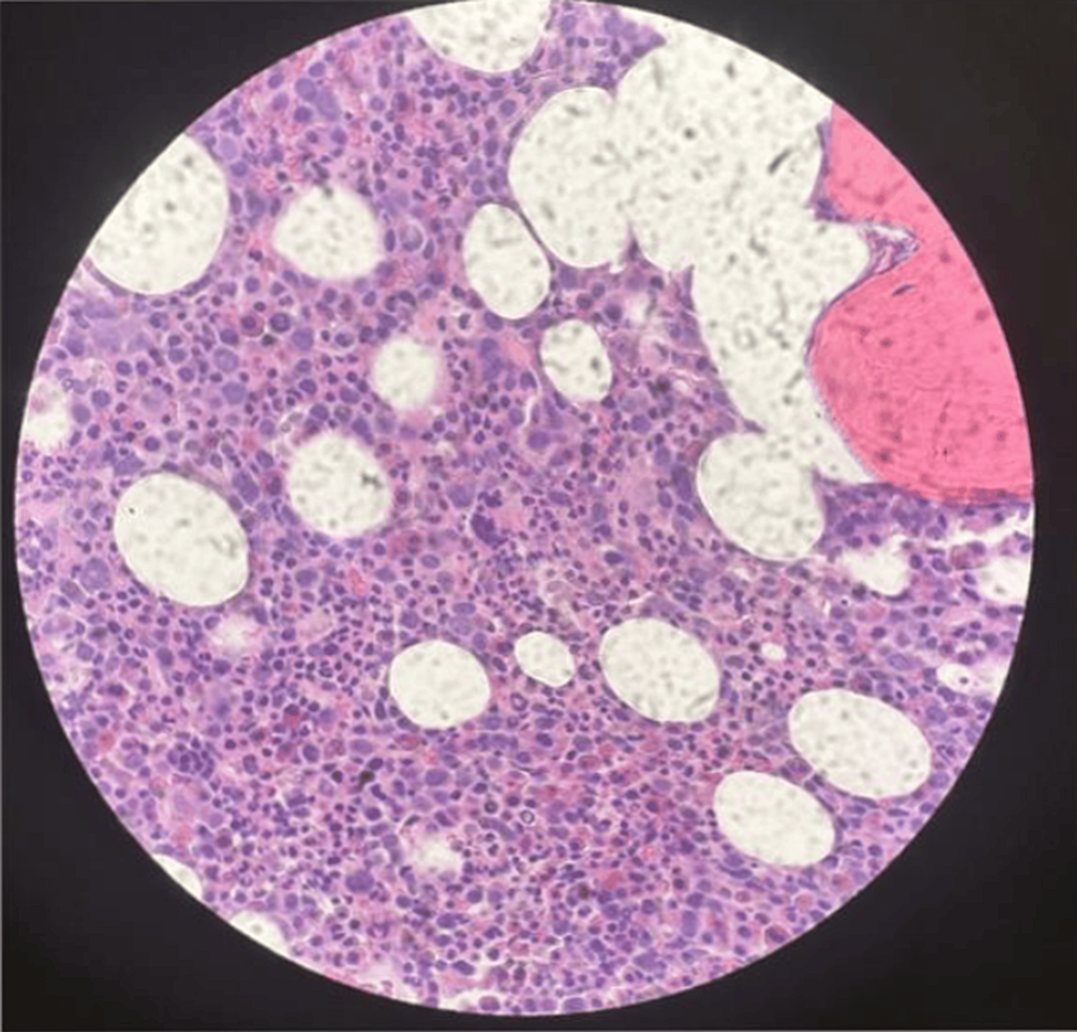 Cooccurrence of HighRisk Myelodysplastic Syndrome With a Complex
