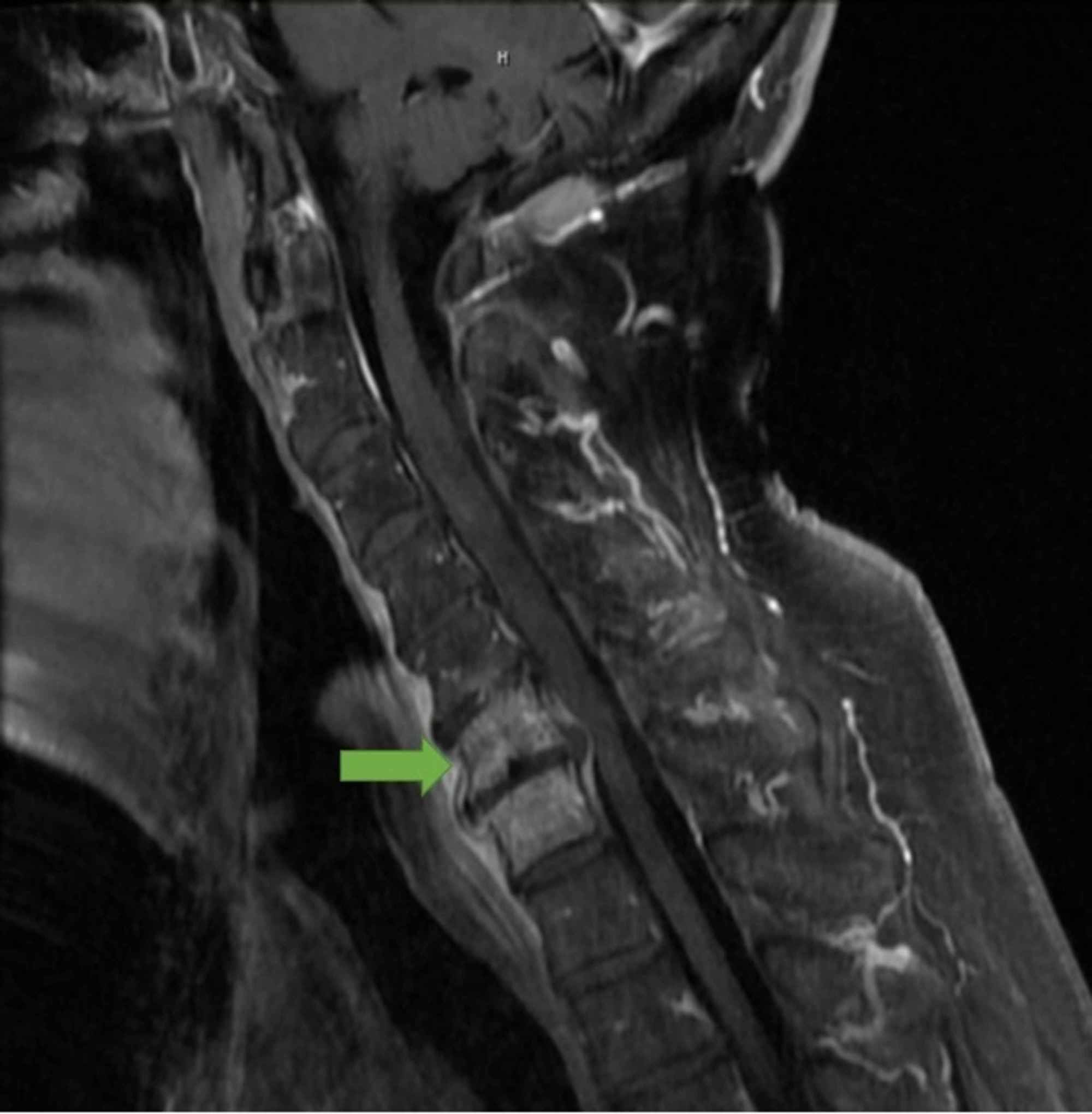 Cureus | Metastatic Osteoarticular Infective Endocarditis by ...