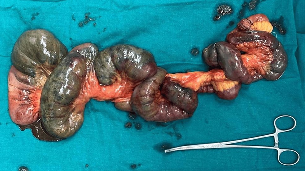 Resected-specimen-of-the-gangrenous-bowel.