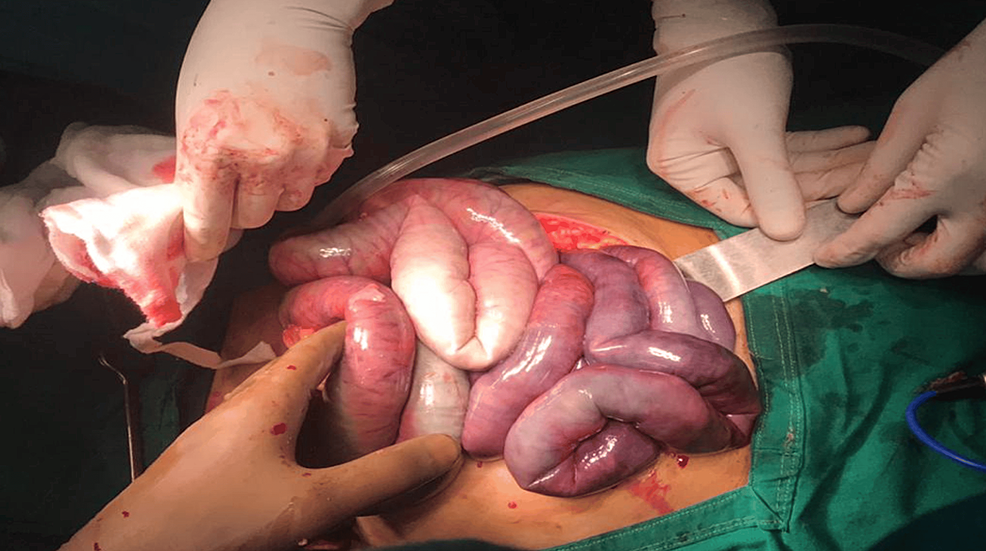 Intra-op-photo-of-the-gangrenous-bowel.