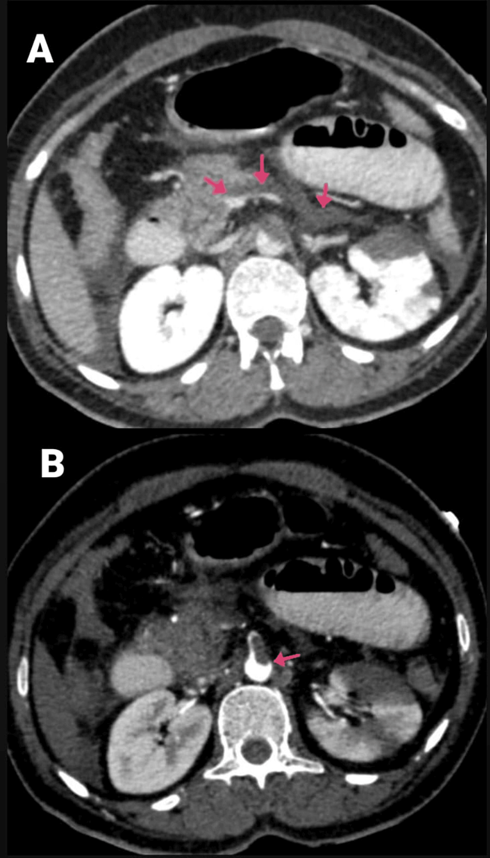 (A-and-B)-CECT-of-the-abdomen-and-pelvis-with-angiography-of-the-patient-(arrows-showing-the-SMA-thrombosis-and-thrombosed-portal-confluence).