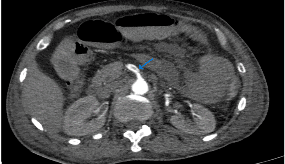 CECT-of-the-abdomen-and-pelvis-of-the-patient.