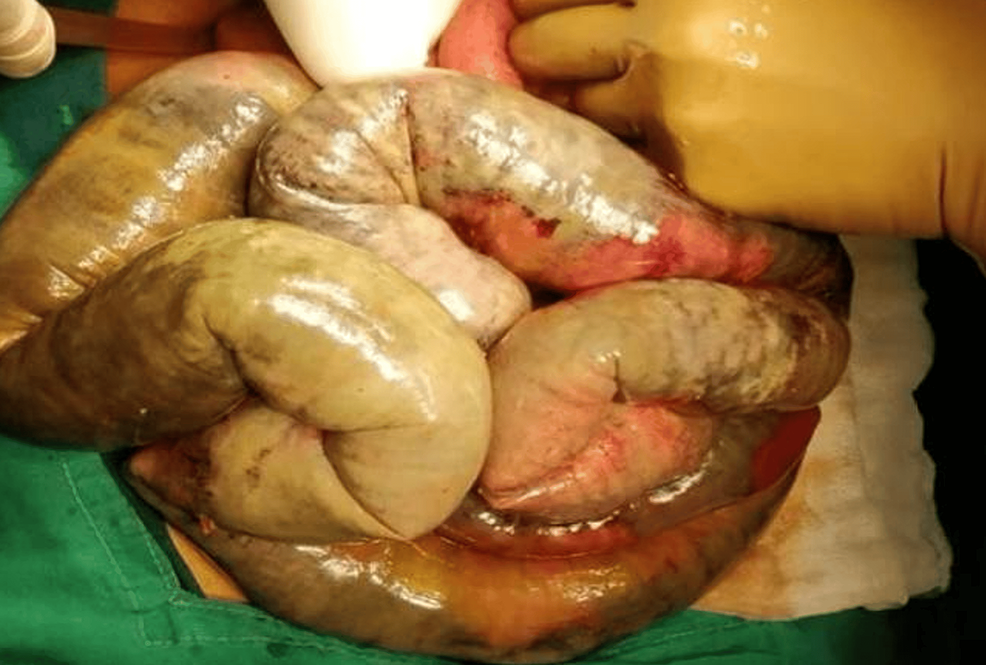 Intra-op-photo-of-the-gangrenous-small-bowel.