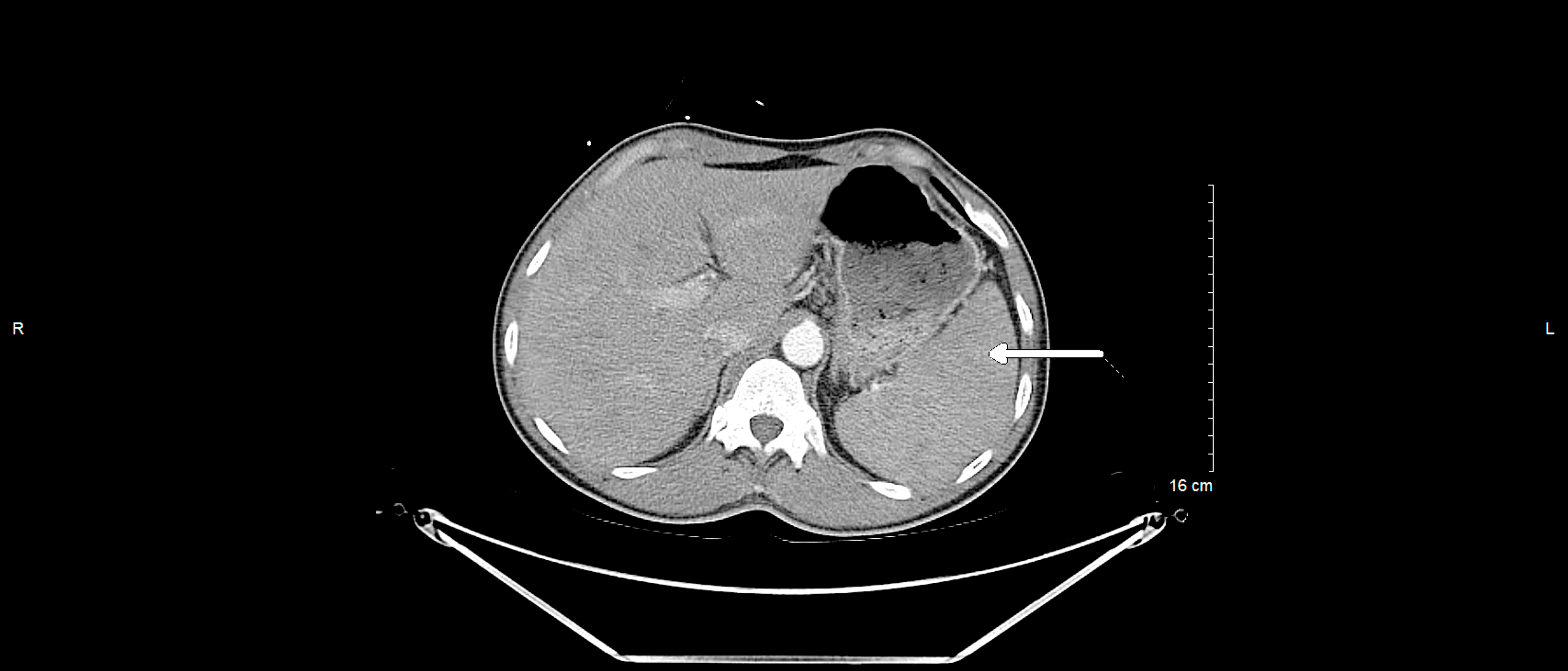 Cureus | Leclercia adecarboxylata in a Patient With Newly Diagnosed ...