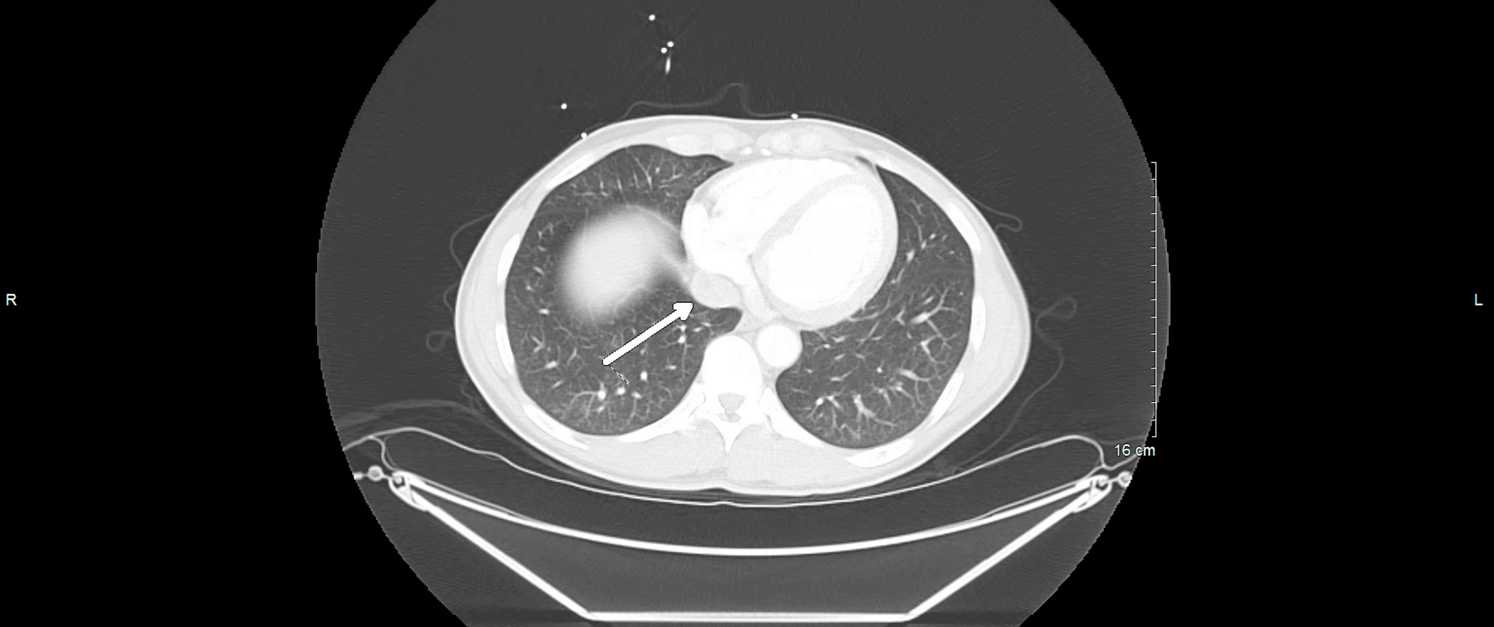 Cureus | Leclercia adecarboxylata in a Patient With Newly Diagnosed ...