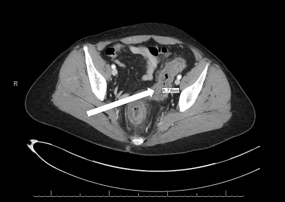 Chemical Colitis Induced by Low-dose Hydrogen Peroxide Enema in a ...