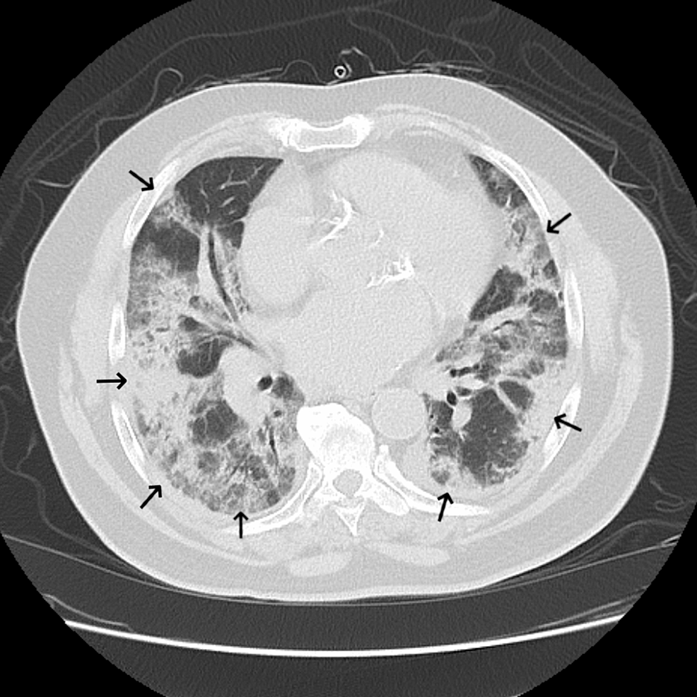 Flecainide-Induced Acute Respiratory Distress Syndrome: A Case Report ...