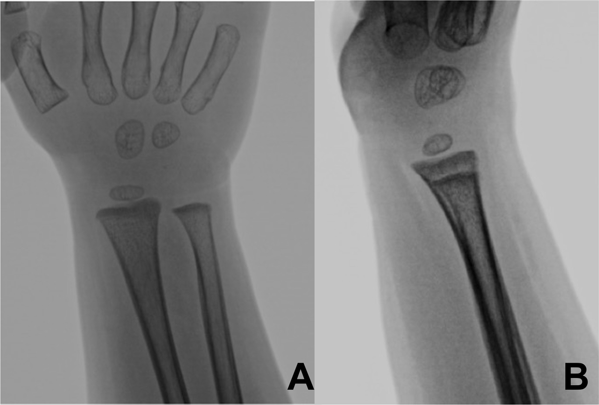 Cureus Septic Arthritis Of The Pediatric Wrist A Case Report And Review Of The Literature