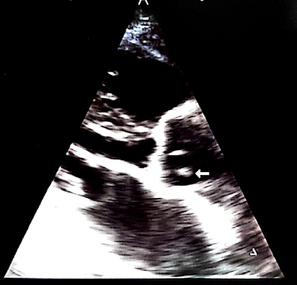 Patient's-echocardiogram-depicting-valvular-vegetations