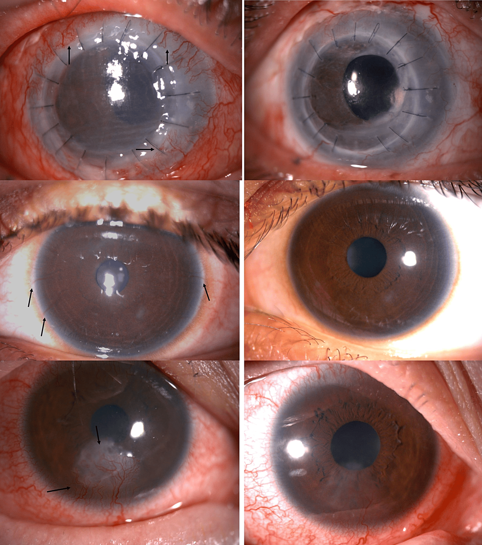 Clinical Outcomes of Topical Bevacizumab for the Treatment of ...