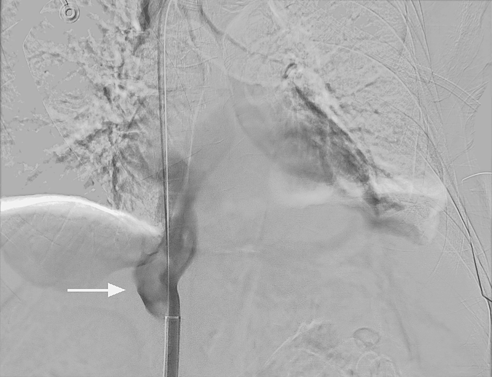 Aspiration Thrombectomy Using Inari Flowtriever System For Inferior