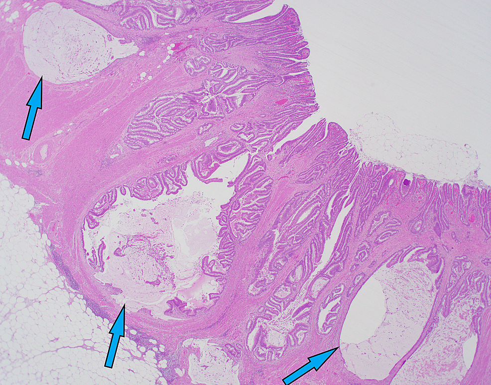 Colitis Cystica Profunda of the Hepatic Flexure A Case Report Cureus