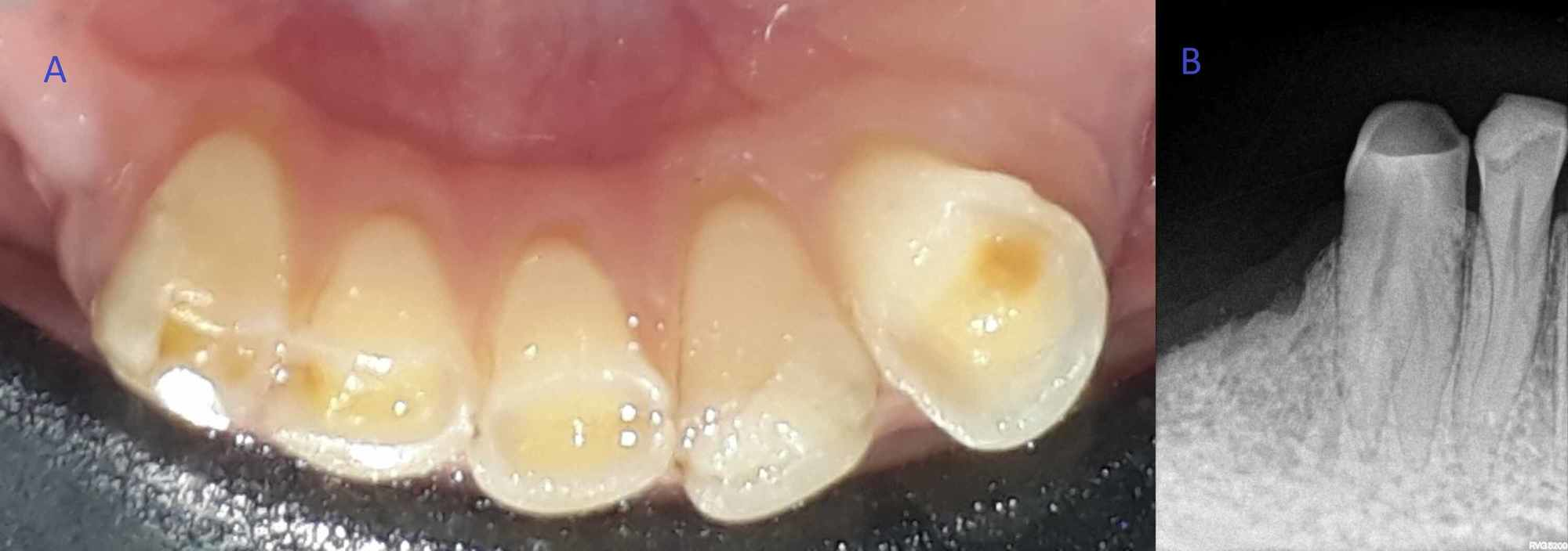 can a root canal be done on a canine tooth