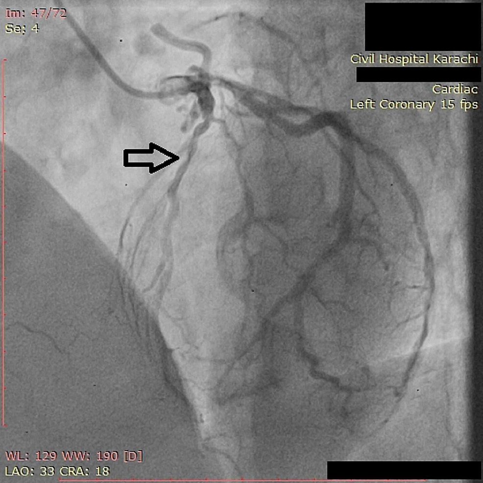 acute-coronary-syndrome-zero-to-finals