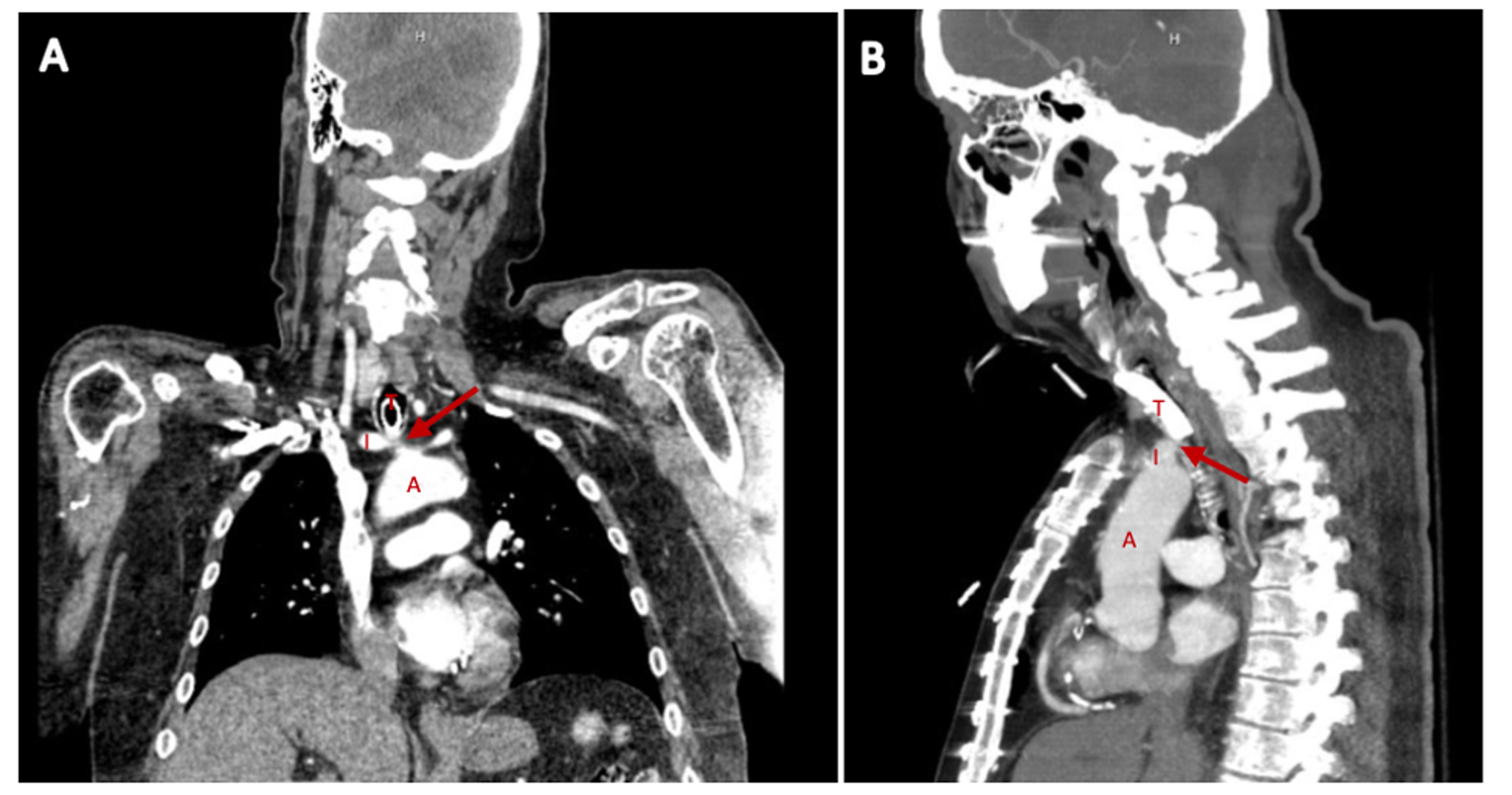 Cureus Tracheoinnominate Artery Fistula Treated With Endovascular