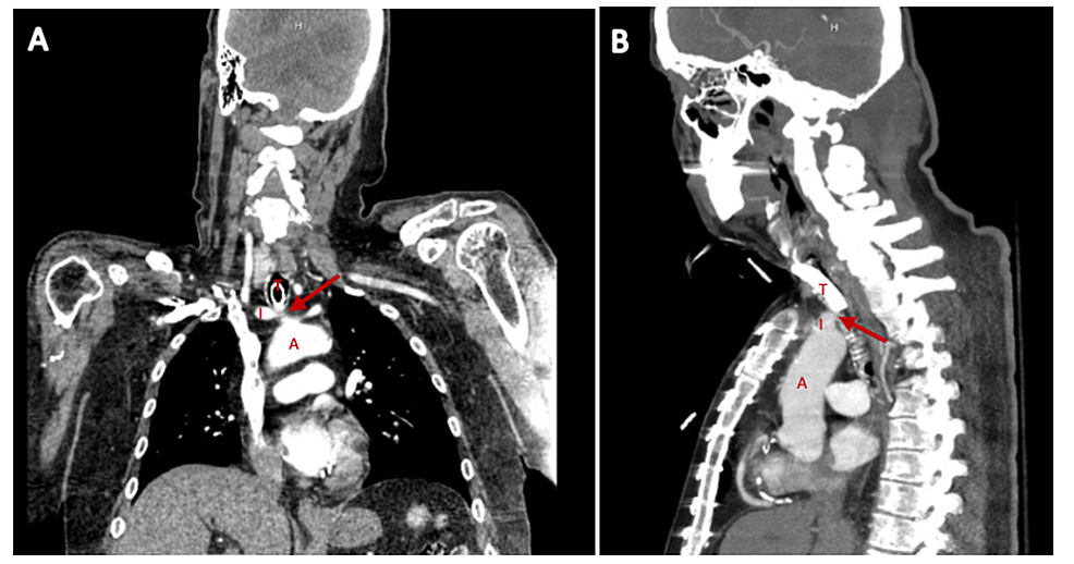 Tracheoinnominate Artery Fistula Treated With Endovascular Stent Graft ...