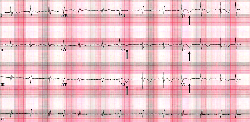 Cureus | Takotsubo Cardiomyopathy in a Nonagenarian With Urosepsis