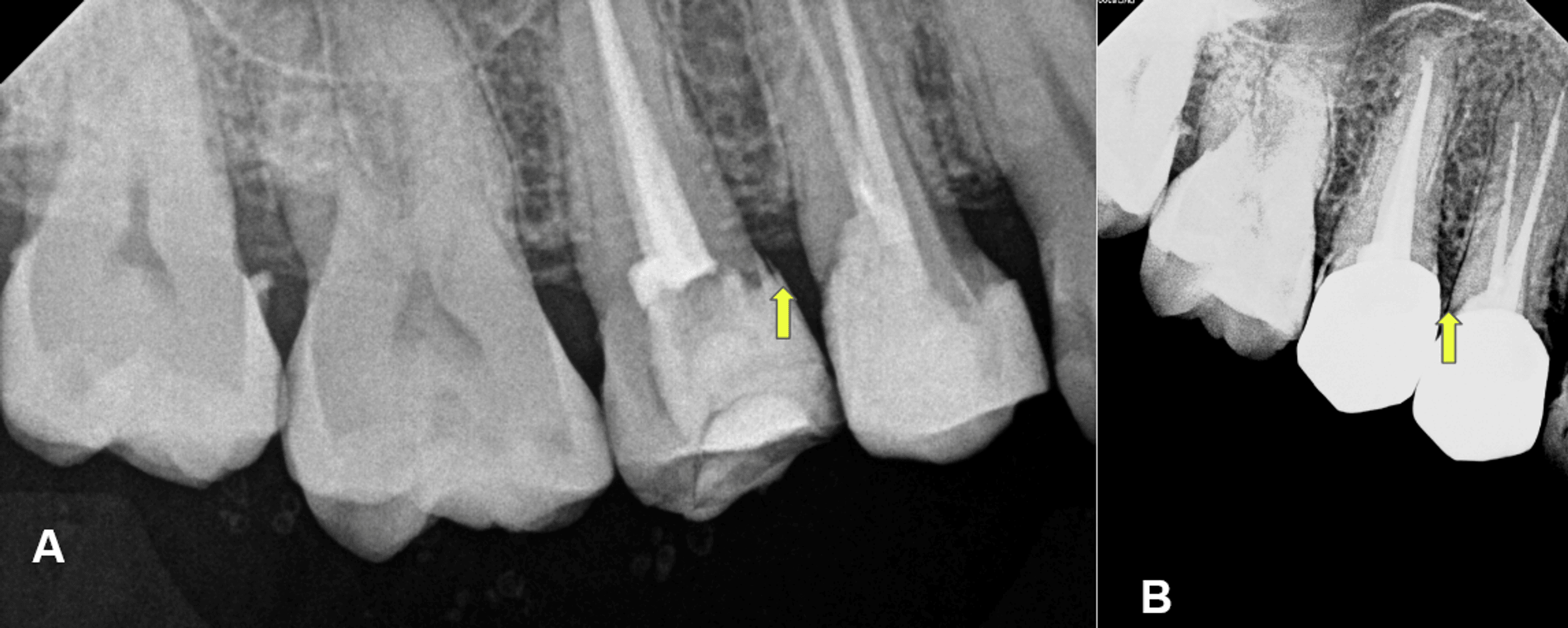 Identification, Evaluation, and Correction of Supracrestal Tissue